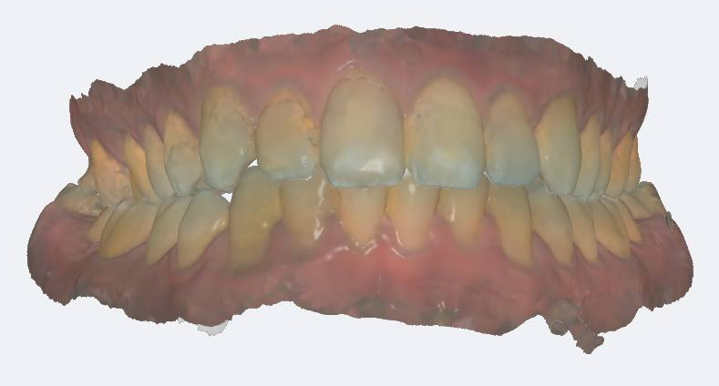 Scanner Intraoral Eagle Scan, Dabi Atlante - Imagen 4